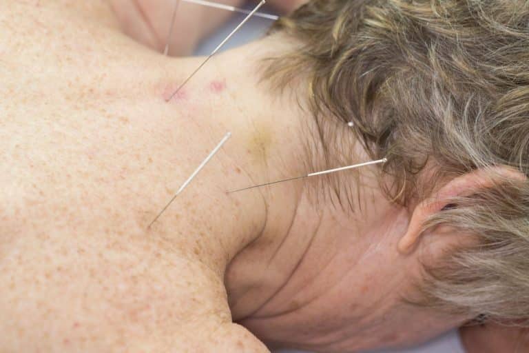 Does Medicare Cover Acupuncture The Medicare Family Does medicare cover acupuncture the medicare family
